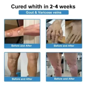 Skavix® Nano-Microneedle Joint Patch