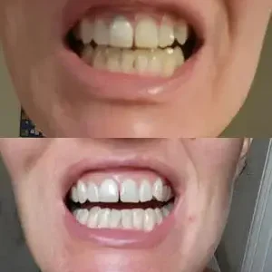 Skavix Stain Whitening Mouthwash for White Teeth, Freshens Breath
 – softfaceglow