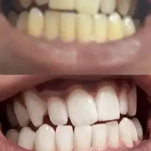 Skavix Stain Whitening Mouthwash for White Teeth, Freshens Breath
 – softfaceglow