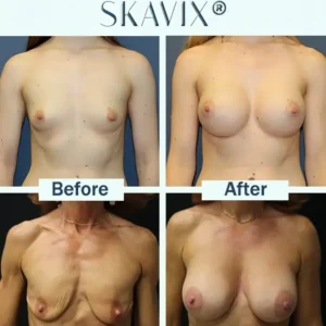 🔥Limited-time 60% sale--Skavix Targeted Breast Enhancement Advanced Nano-Microneedle Patches